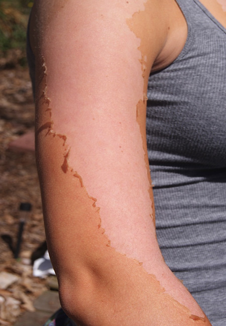 When exposed to UV radiation, the skin undergoes damage such as peeling. Frequent damage can increase an one’s susceptibility to various types of melanoma skin cancer.